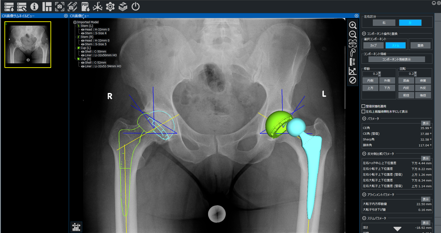 ZedView2.5D (Hip/Knee/Traumaに対応) - 医療ソフトウェアの株式会社 