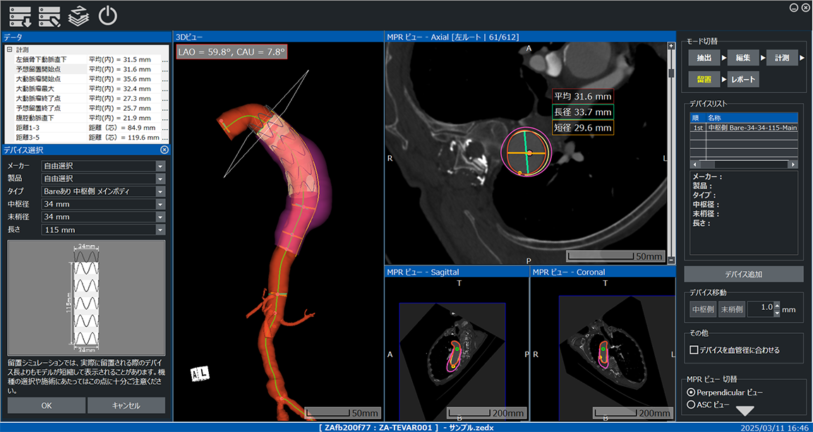 ZedStent-graft - 医療ソフトウェアの株式会社レキシー